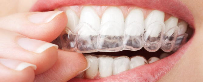 Invisalign Teen vs. Adult: Key Differences